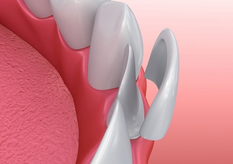 teeth Veneers - croatia dental centar